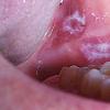 Oral Trichomonas At what age do Trichomonas begin to destroy teeth?