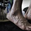 Čo robiť, keď máte kŕče v nohách: príčiny poruchy, symptómy patológií, účinné terapeutické metódy