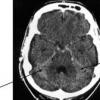 Sintomi e trattamento dell'emorragia cerebrale subaracnoidea
