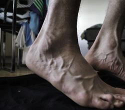 Какво да правите, когато имате крампи на краката: причини за заболяването, симптоми на патологии, ефективни терапевтични методи