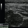 Diagnosi ecografica delle articolazioni dell'anca (HJ) nei bambini - norme angolari e tipi di deviazioni Angoli delle articolazioni dell'anca secondo il grafico