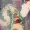 Trattamento dei sintomi della sindrome dell'intestino irritabile Trattamento del colon irritabile