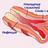 Cistična fibroza - kaj je to?