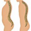 Come si chiama la curvatura della colonna vertebrale?