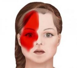 Migrena - shkaqet, simptomat dhe bazat e trajtimit Gjithçka rreth migrenës